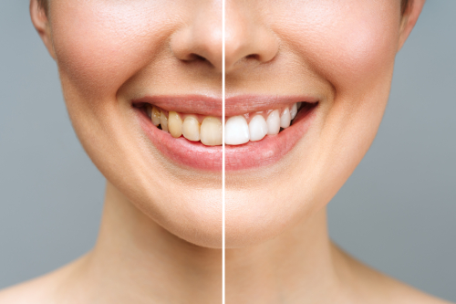 Blanqueamiento dental seguro